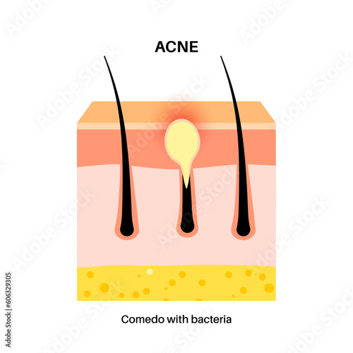 Acne treatment poster