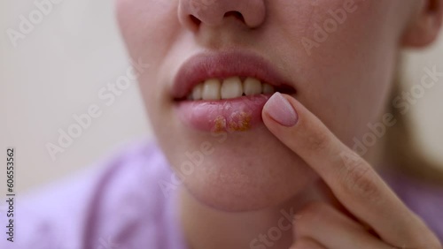cold sores hpv virus herpes on girl female big beautiful lips.woman applying cream for treatment or healing patch.girl putting finger feeling pain, ouch gesture.4k video slow motion