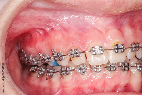 Lateral oblique view of dental arches in biting teeth occlusion with molar bite-raising blue resin material, orthodontic braces, arch wire, healthy gingival gum, lips retracted with cheek retractor.