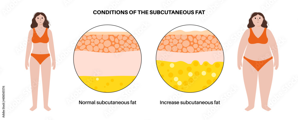 Obraz na plátně Obesity fat level