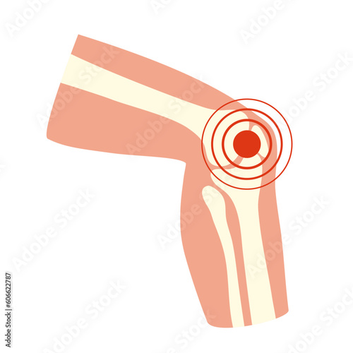 Arthritis joint pain concept vector illustration. Human knee pain.