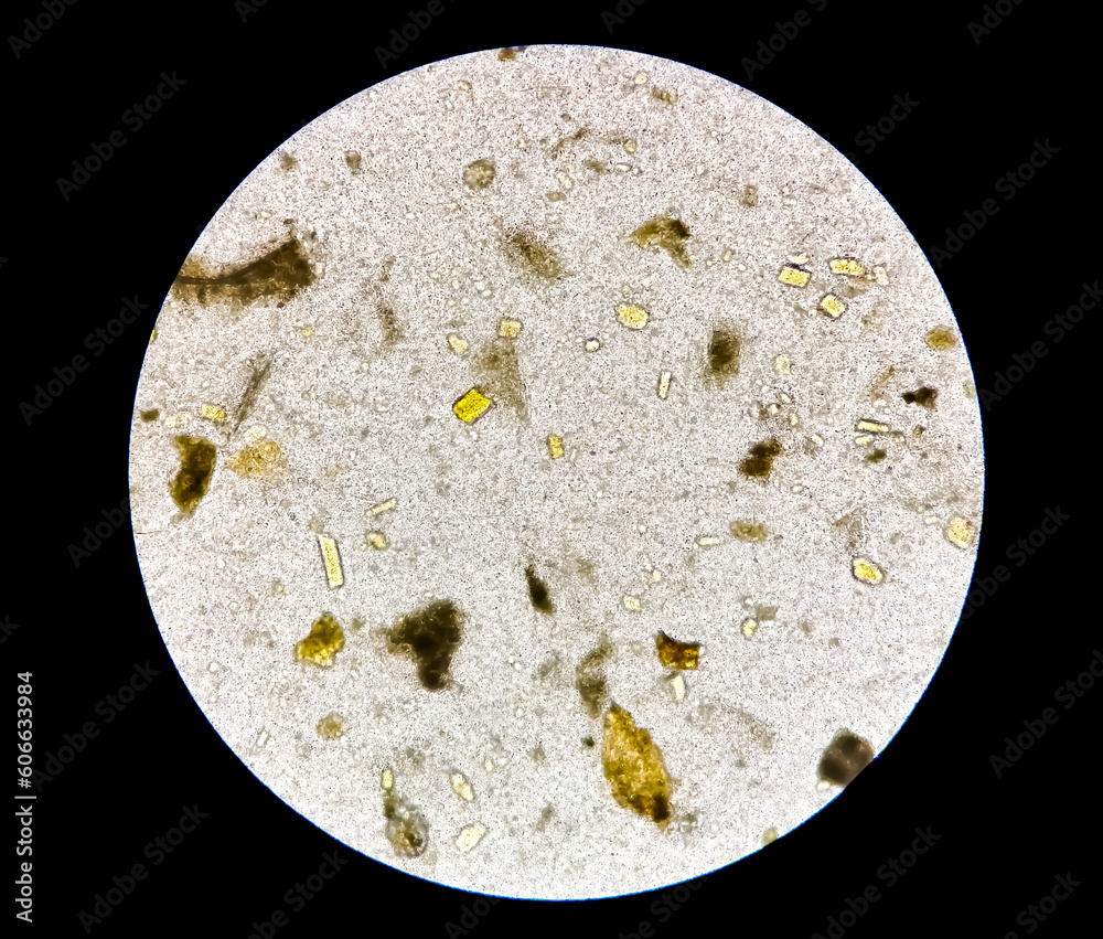 Stool analysis. Microscopic examination of human stool, abnormal report