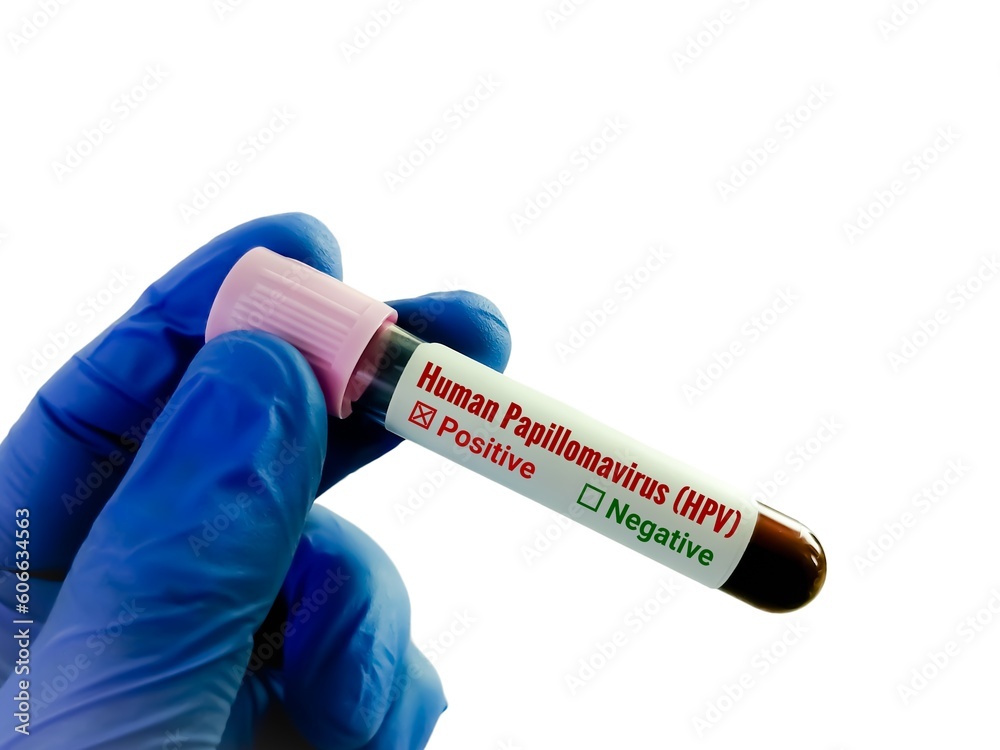 Fototapeta premium Doctor or lab technician holding blood sample for HPV VIRUS (Human Papillomavirus) test.