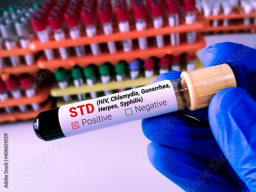 Foto Biochemist or Lab Technologist holds Blood sample for STD or Sexually Transmitted Disease Test with laboratory background