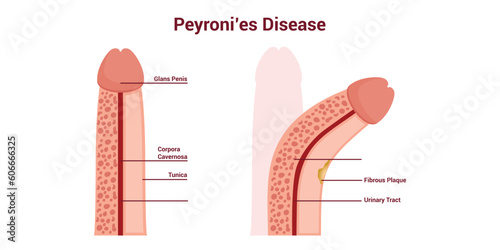 Peyronie's Disease Medical Vector Illustration