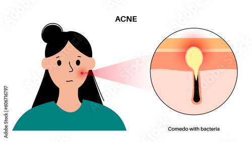 Acne treatment poster