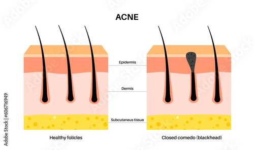 Acne treatment poster