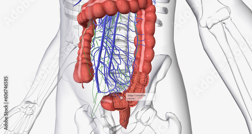 Colorectal cancer (CRC) is a common colon or rectal cancer that affects many patients over middle age.