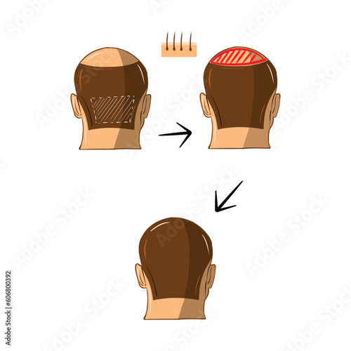 Vector Illustrated set with hair transplant surgery. Infographics with icons of plastic surgery procedures.