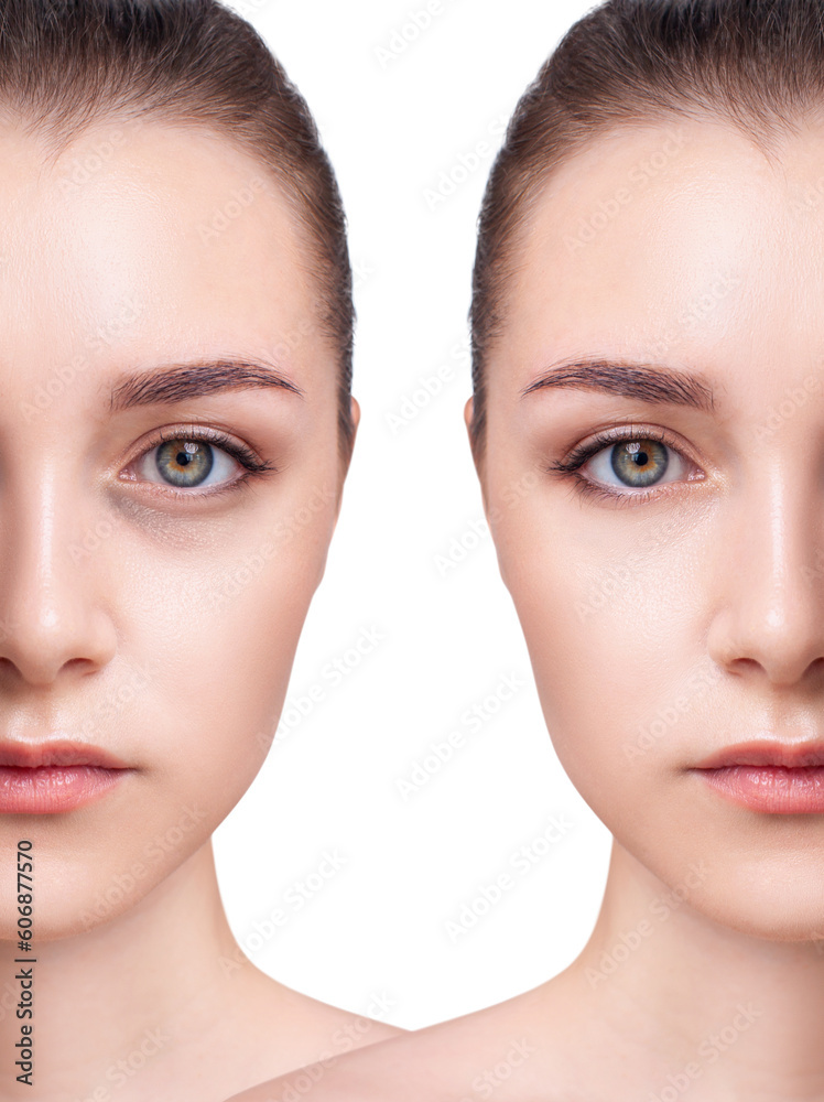 Young woman with bruises under eyes before and after treatment. Young woman with bruises under eyes before and after treatment.