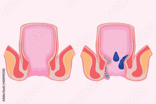 piles. hemorrhoidal disease. comparison and differences between healthy rectum and part of a large intestine with internal and external hemorrhoids, Pectinate line and Rectal bleeding