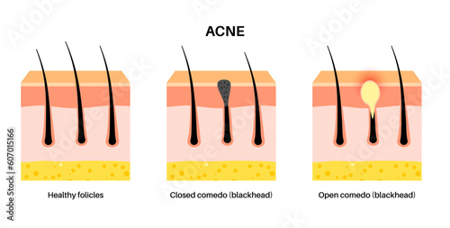 Acne treatment poster
