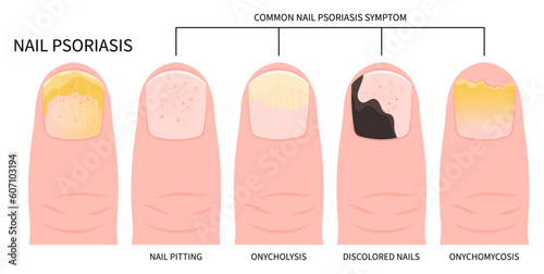 Yellow peeling toes nail pain health and Beau's line syndrome white bands ridge damage of split care Tinea liver zinc iron crumbly fissure bed matrix spots big spoon or onycholysis kidney cancer