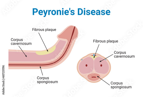 Peyronie's Disease Medical Vector Illustration photo