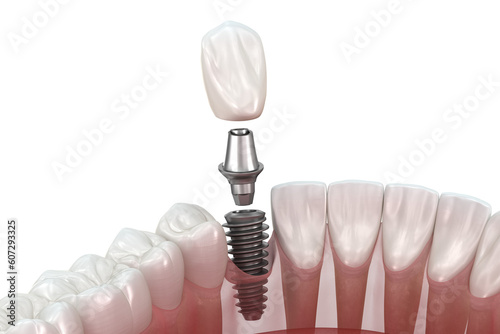 Tooth recovery with implant. 3D illustration with transparent background