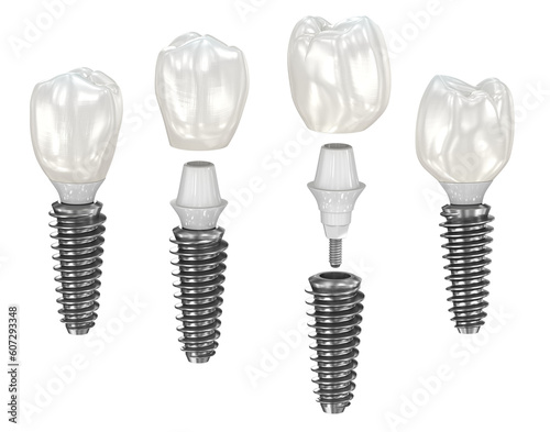Dental implant and ceramic crown. Medically accurate 3D illustration with transparent background photo