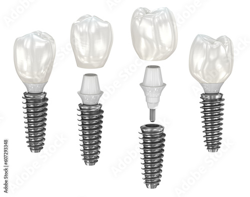 Canvastavla Dental implant and ceramic crown