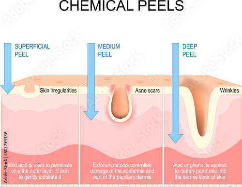 Chemical peels. Exfoliation