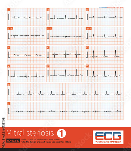 Female, 51 years old, diagnosed with mitral stenosis. When this ECG was taken, the patient still maintained sinus rhythm.Note that the P wave duration was widened.