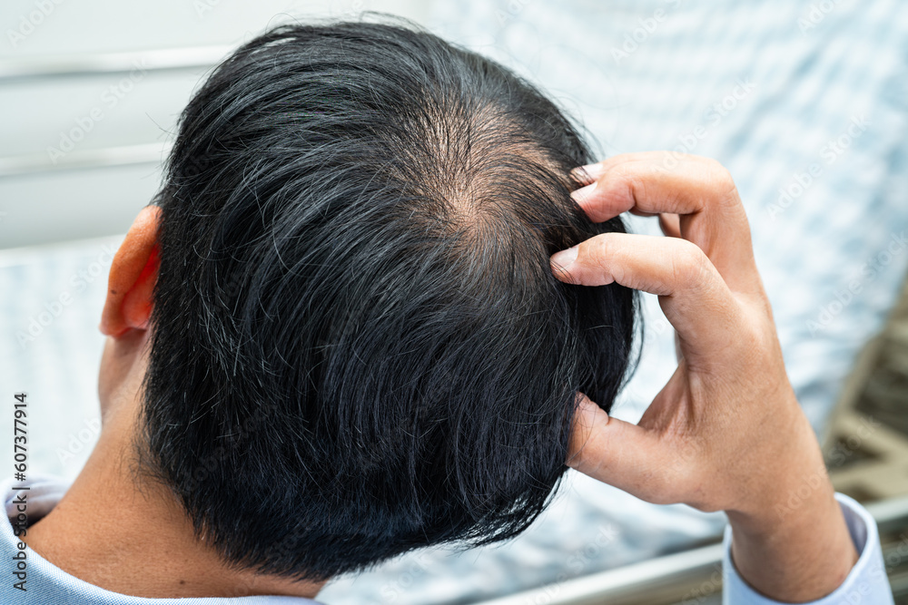 Fototapeta premium Bald in the middle head and begin no loss hair glabrous of mature Asian business smart active office man.