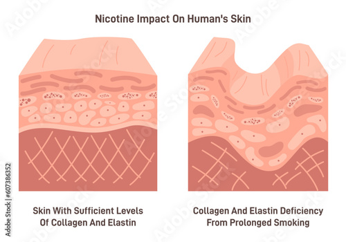 Nicotine impact on human skin. Cross section of epidermis, reduction