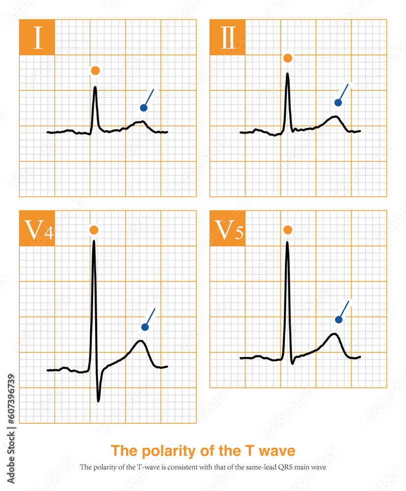 On the 12-lead ECG, under normal circumstances, the T wave polarity of most leads is consistent with the polarity of the main wave of the same lead QRS