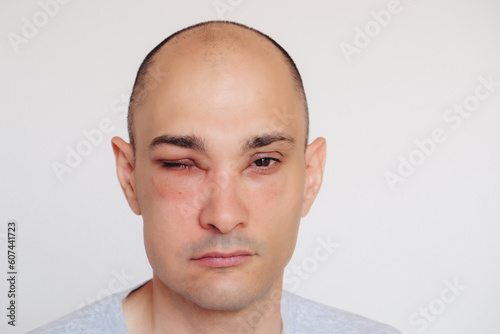 Caucasian man has angioedema around the eyes caused by allergic reaction to agents such as insect bites, foods, or medications. Swollen face.