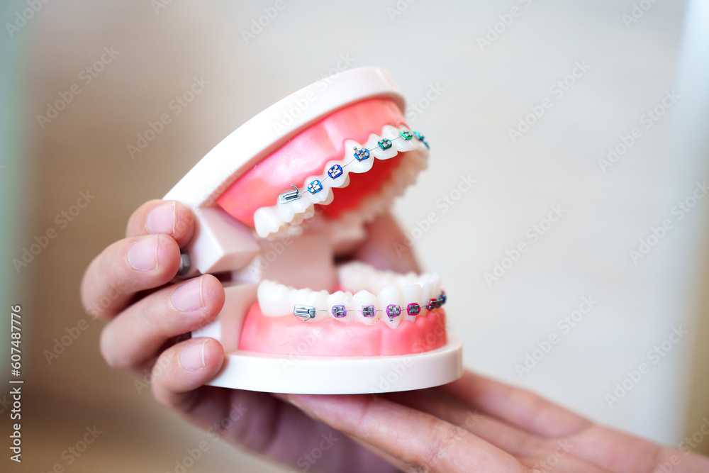 Hand holding braces model in dental clinic, Braces or teeth