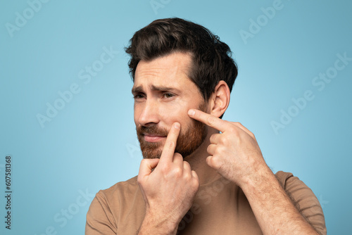 Bearded middle aged man touching his face, removing blackheads, pressing pimple on face with fingers, blue background