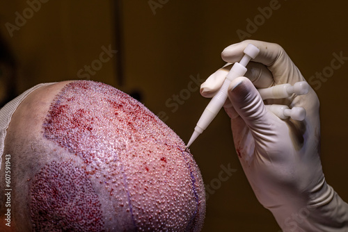 Hair transplant dhi and fue system. Hair Transplant patient after the operation. Surgeons in the operating room carry out hair transplant surgery. photo
