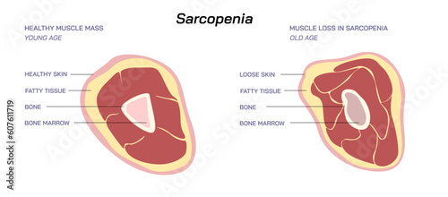 Loss of muscle mass and strength Sarcopenia vector illustration. Difference between Young age muscle mass and Old age muscle mass. 