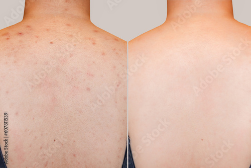 Фотография Closeup young woman's back with red rash skin and acne scar on especially on shoulder