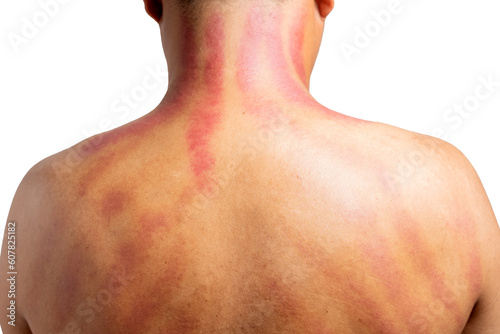 The red mark on the man's back was caused by Gua Sha. Gua sha is a natural alternative therapy to improve blood circulation or to cure cold symptoms photo