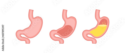 Healthy and unhealthy, empty and full human stomach in trendy flat style. Nutrition, stomach pain, bloating. Digestive system anatomy. Vector illustration isolated on white background photo