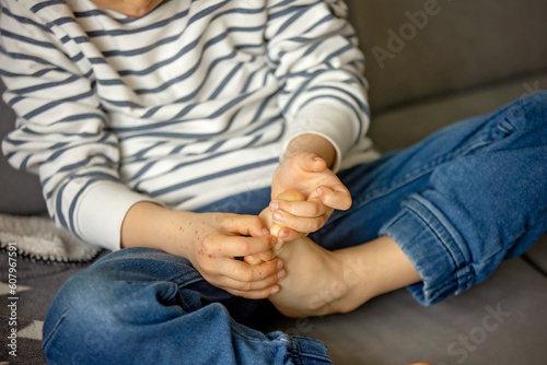 Child with skin rash, roseola. Hand-foot-and-mouth disease. Enterovirus Leg arm mouth Rash on child. Cocksackie virus