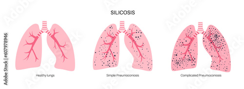 Silicosis dust in lung