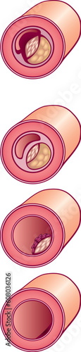 Illustration of bad cholesterol in vein section