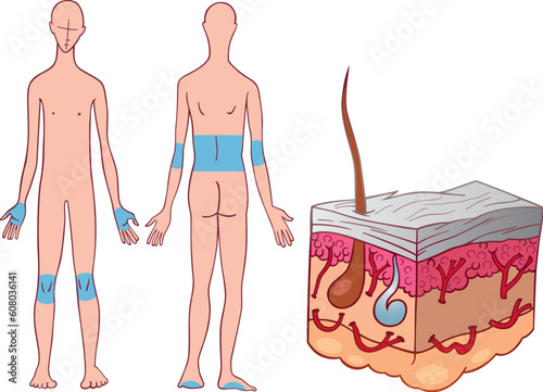 Canvas Print Illustration of psoriasis skin disease