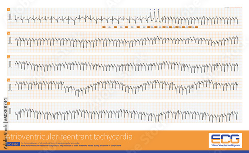 A 1-month-old child developed atrioventricular reentrant tachycardia. At the beginning of the attack of tachycardia, three wide QRS waves appeared successively, which was complete LBBB. photo