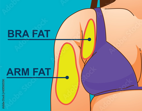 A woman's body with problem areas. Bra bulge. Medical infographic. Healthcare illustration. Vector illustration. 