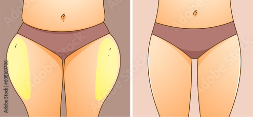 A woman's body with problem areas. Before, after. Medical infographic. Healthcare illustration. Vector illustration.