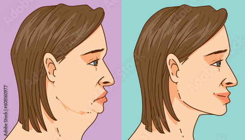 Double chin. The man with the age problems on her face. Before, after. Face correction. Healthcare illustration. Vector illustration.  photo