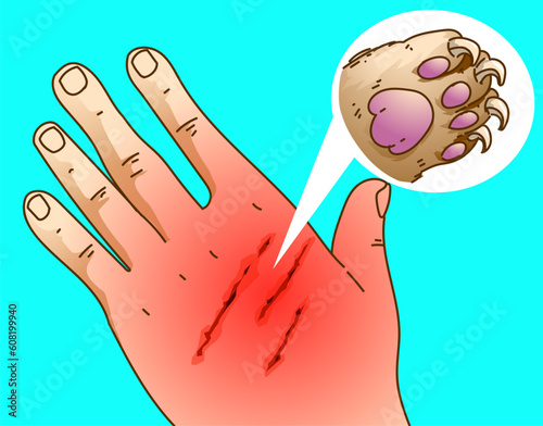 Cat scratched human's hand. Skin infection. Inflammation. Healthcare illustration. Vector illustration.