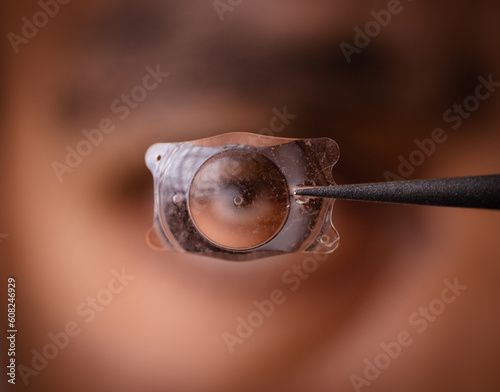 Tableau sur toile photo of Implantable Collamer Lens ICL for treating refractive errors, infront o