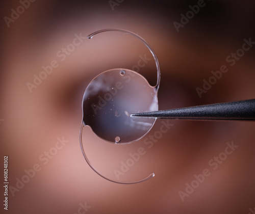 photo of intra ocular lens IOL for treating cataract infront of surgeon eye photo