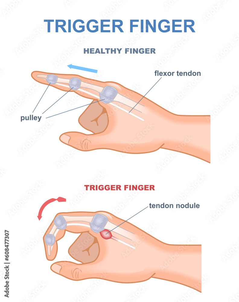 Trigger finger diagram. Joints stuck in bent position. Anatomy of