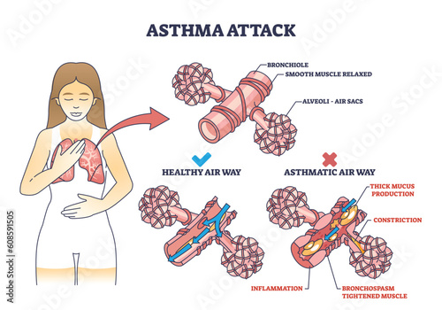 Asthma attack explanation compared with healthy air way outline diagram. Labeled educational scheme with mucus production and inflammation in lungs vector illustration. Anatomical respiration system.