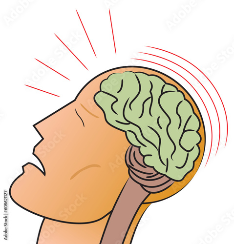 A stylized depiction of a man receiving a traumatic head injury or concussion.