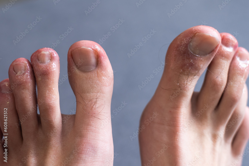 A man's toes showing what looks like a rash with red blotchy skin. A common side effect of Covid-19 often referred to as Covid toe . A man's toes showing what looks like a rash with red blotchy skin. A common side effect of Covid-19 often referred to as Covid toe .