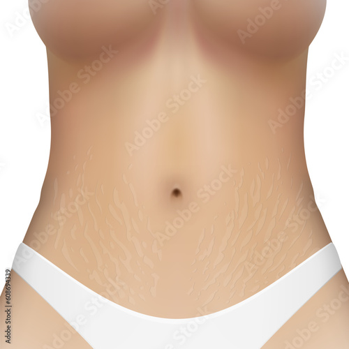 Realistic Woman Body Laser Strechmarks Removal Ad
